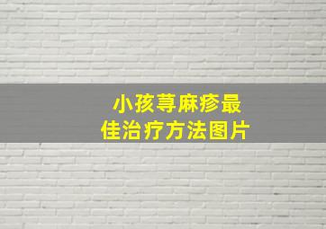 小孩荨麻疹最佳治疗方法图片