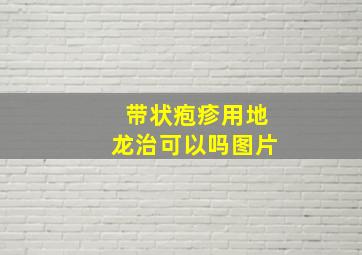 带状疱疹用地龙治可以吗图片